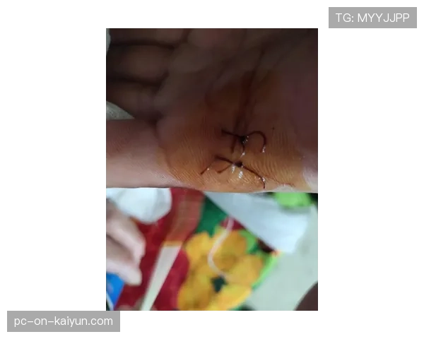 脚趾甲脱落后缠上绷带继续跑，脚指甲掉了纱布拿不下来了该怎么办